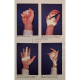 D. W. Lamb - Hand conditions - 1984 - Brosata